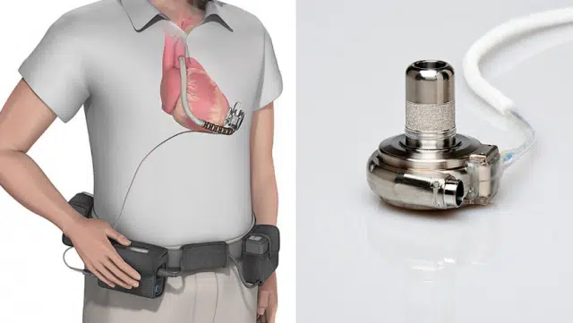 On en sait plus sur la première implantation d'une pompe cardiaque électrique au Maroc On en sait plus sur la première implantation d'une pompe cardiaque électrique au Maroc
