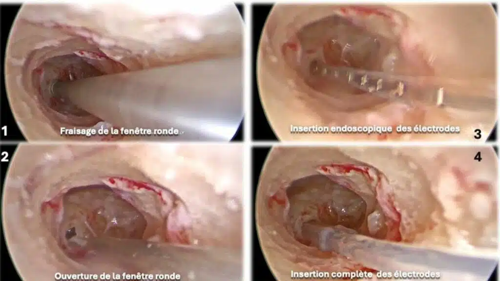 Première au Maroc, une implantation cochléaire réalisée sous guidage endoscopique Première au Maroc, une implantation cochléaire réalisée sous guidage endoscopique