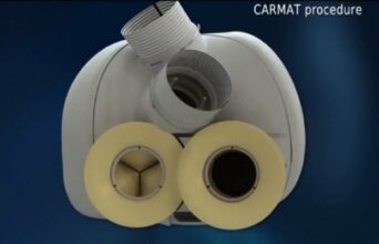 Décès du premier patient ayant reçu un coeur artificiel