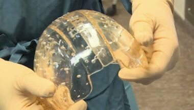 Première mondiale : des chirurgiens implantent un crâne réalisé en impression 3D