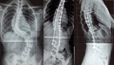 Scoliose: Interventions au profit de 5 patients bénéficiant du Ramed