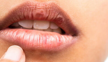 ''Mard Nchoufia'', maladie rare éclipsée par le Covid en cette journée mondiale