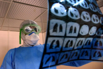 Le ministère de la Santé mène une enquête sur la hausse des cas de tuberculose