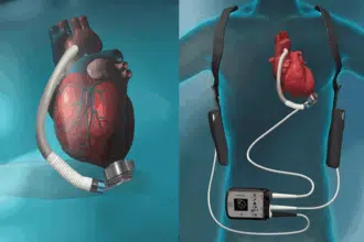 On en sait plus sur la première implantation d'une pompe cardiaque électrique au Maroc