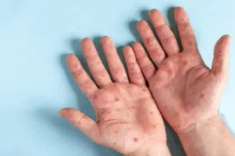 Variole du singe (Mpox) : la propagation, les symptômes et les mesures à prendre au Maroc